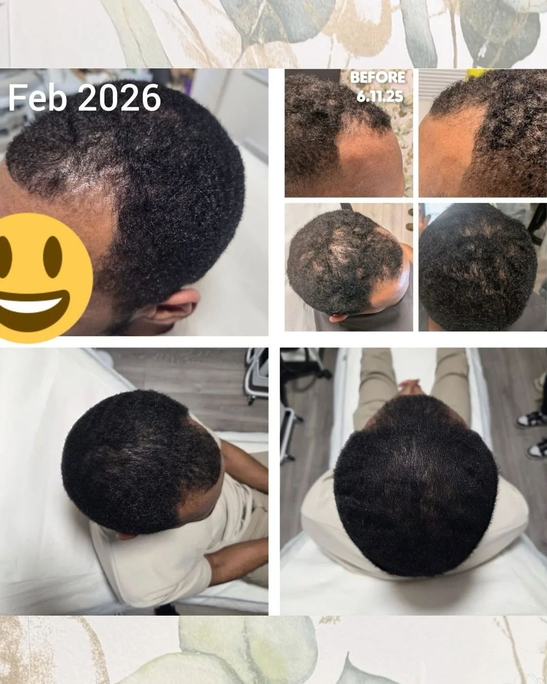 Incredible results from our iPRF for hair regrowth treatment! 😮 If you&rsquo;re struggling with hair loss, this is the treatment to try. Send us a DM to book a consultation or visit our Bromley clinic&rsquo;s website.