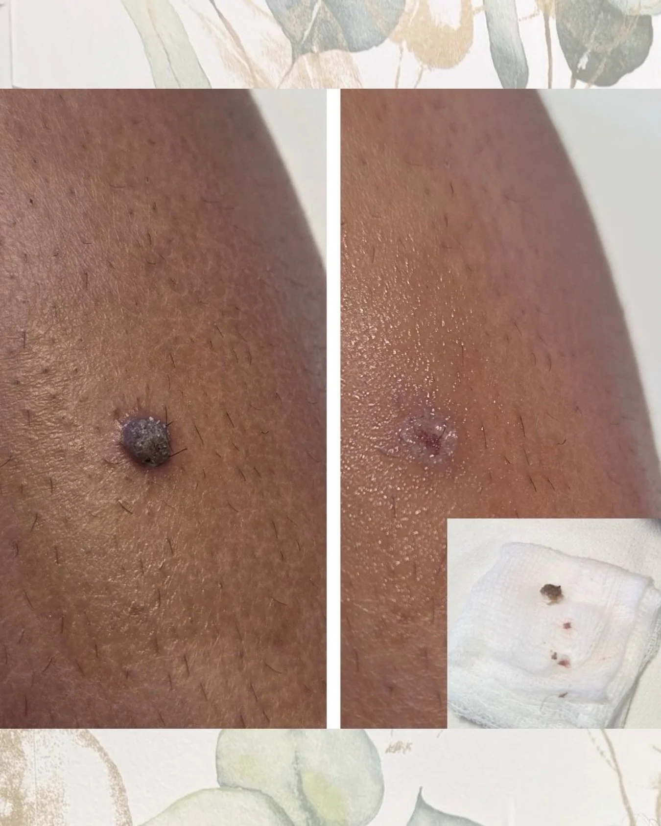 Sorry if you&rsquo;re squeamish but blemish removal is one of the most popular treatments we offer at Becky Laroc Beauty &amp; Aesthetics, and certainly nothing to be embarrassed about!

We can treat skin tags, milia, cherry angiomas, seborrheic kera