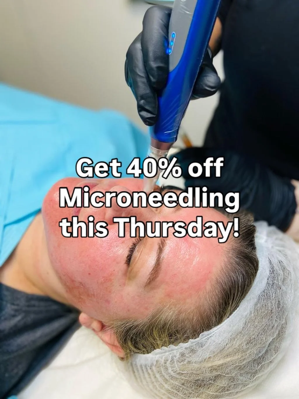 Get 40% off Microneedling this Thursday (16th April) at our Bromley clinic!📍

Nayle is running a special limited-time offer on Microneedling. Get your treatment for just &pound;120 - saving a whopping &pound;80! 🤩

This offer is open to new clients