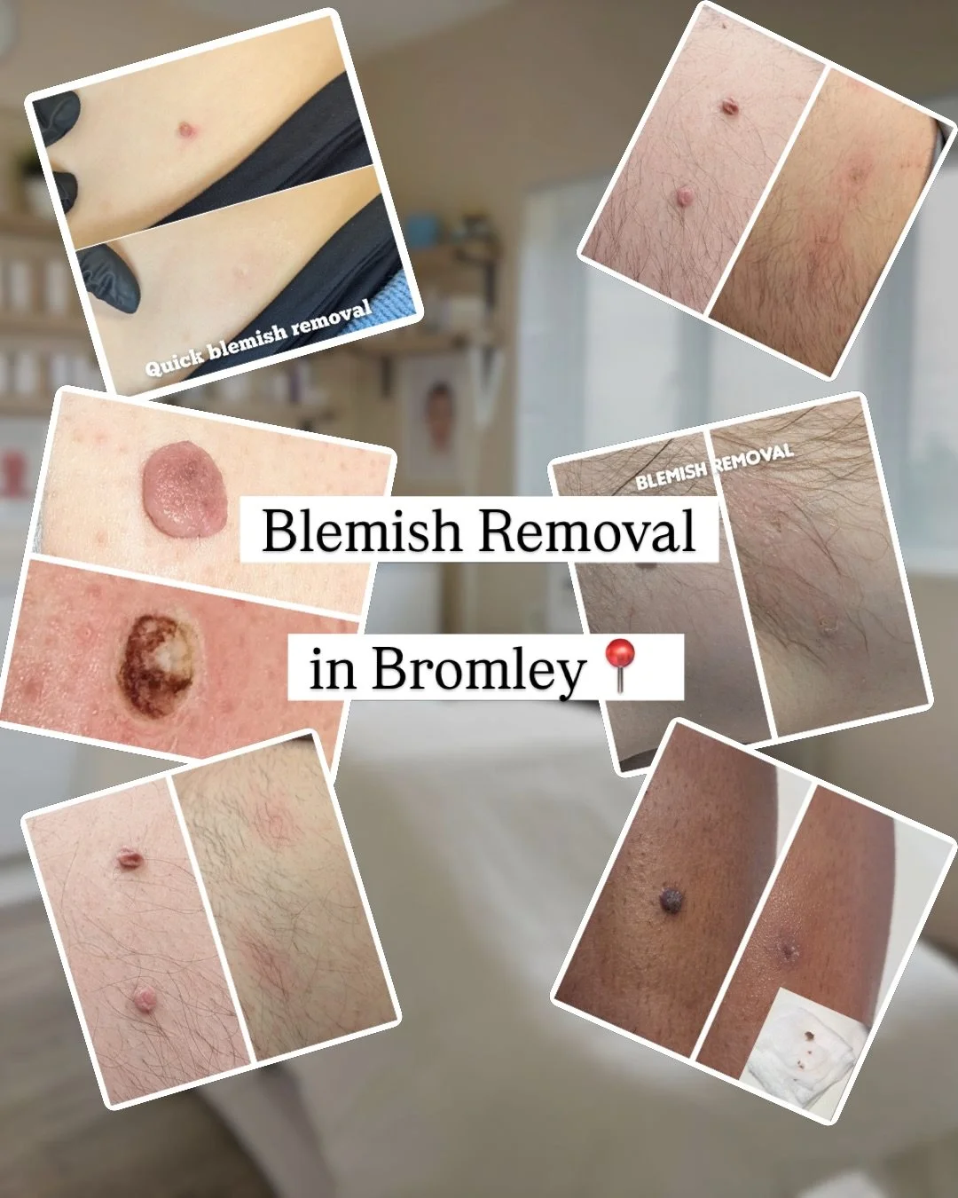 Most skin blemishes can be removed quickly in a single session with our Cryotherapy and Electrocautery treatments.

Book a consultation at our Bromley clinic and we&rsquo;ll assess your skin, discuss your concerns and recommend the best approach. DM 