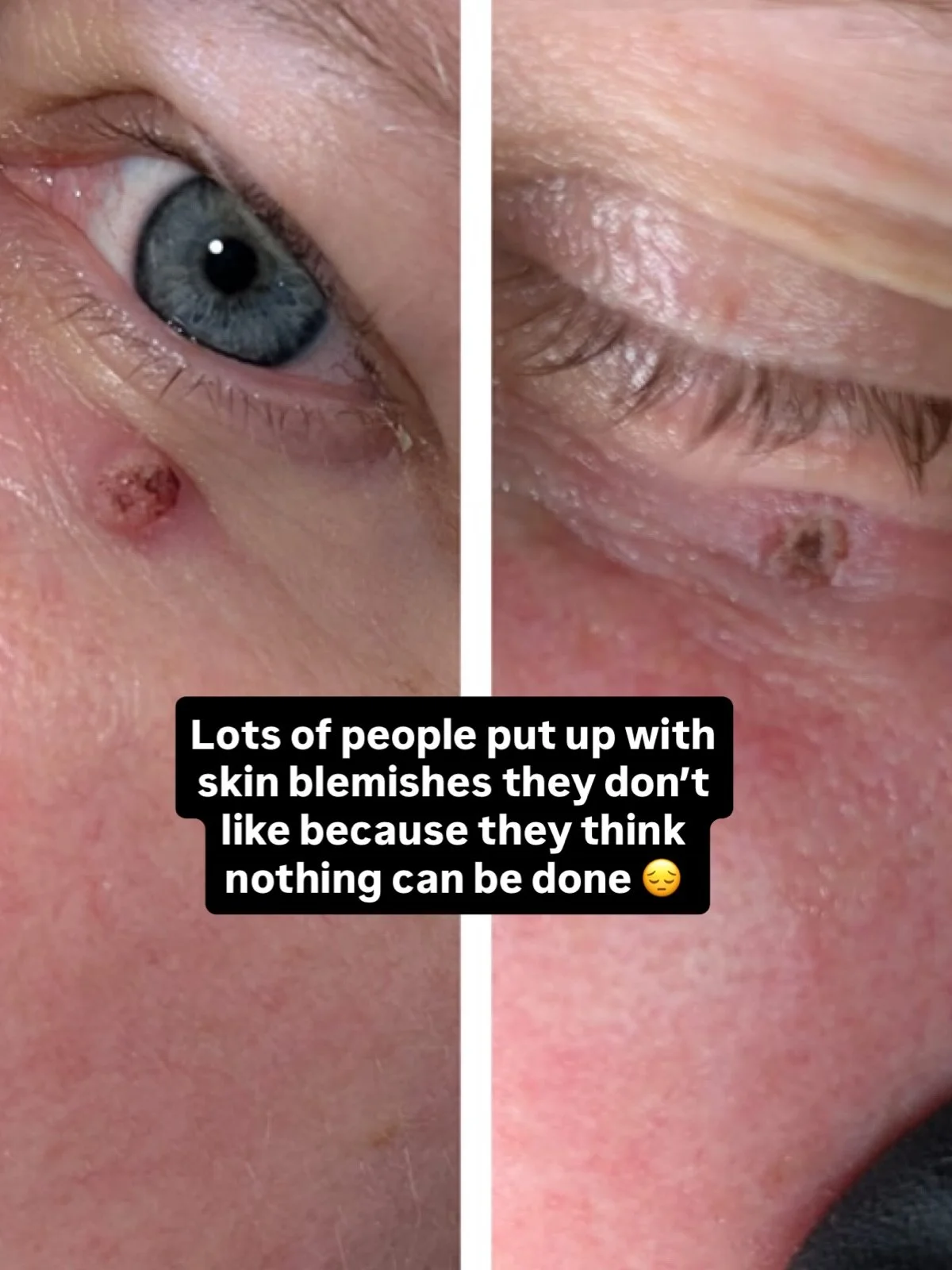 You don&rsquo;t have to just put up with skin blemishes that you don&rsquo;t like!

Restore your body confidence with Electrocautery and Cryotherapy skin blemish treatments - both available at our skin clinic in Bromley. 📍

We can treat a range of d