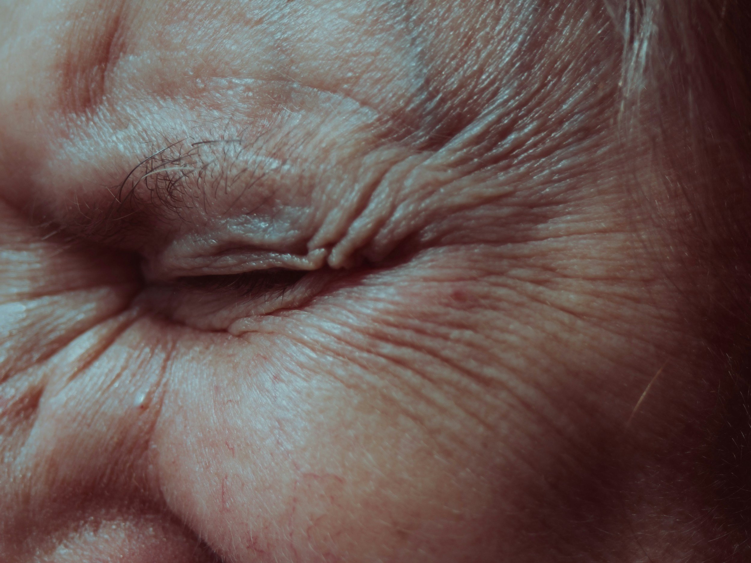 Reduced fine lines