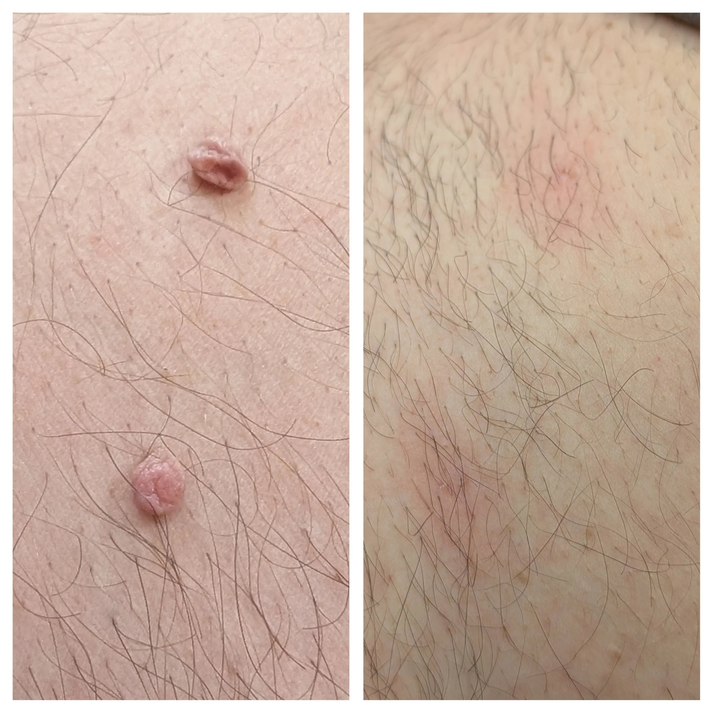 Successful removal of two skin tags