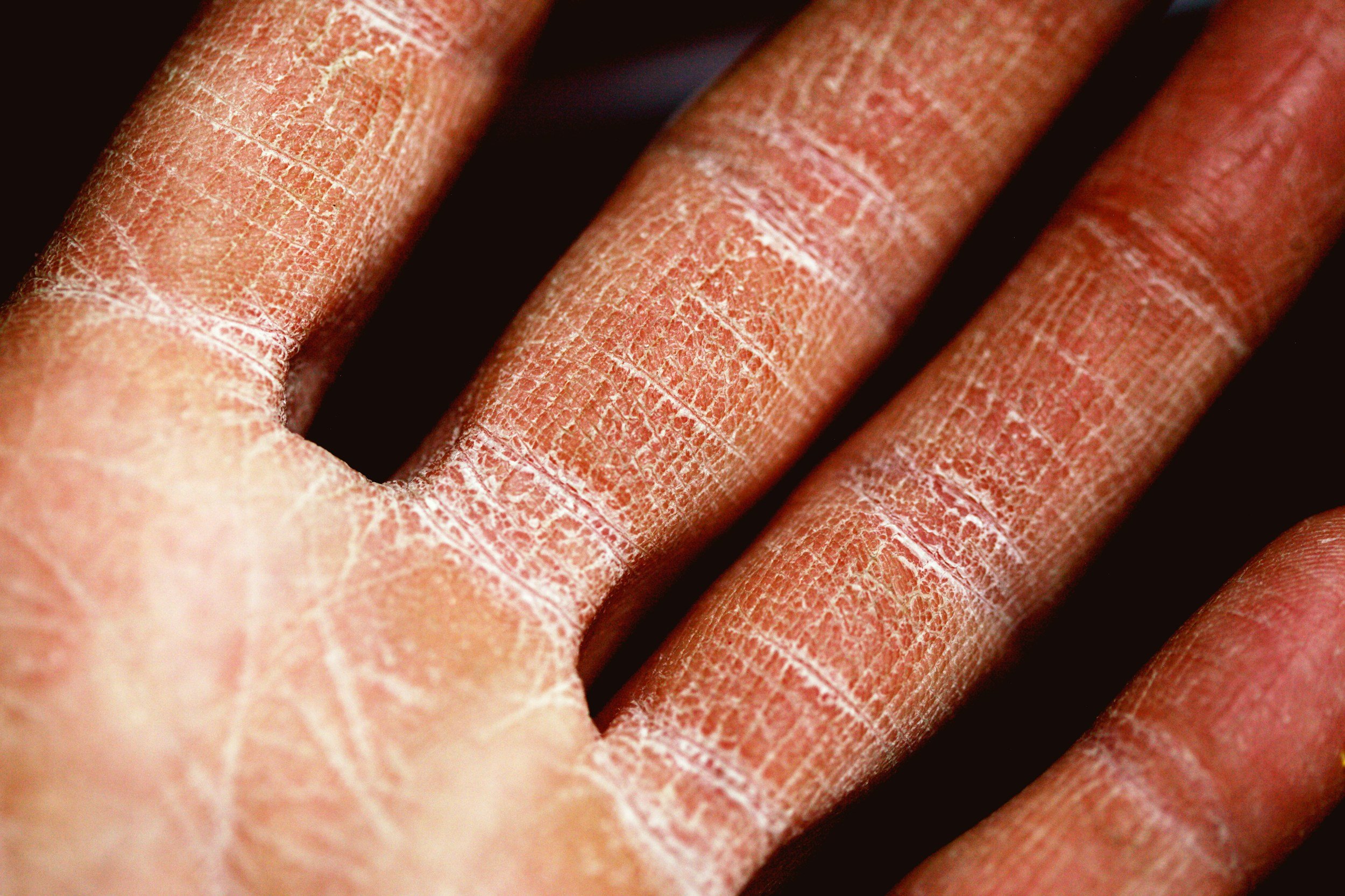 Close-up of a hand with dry, cracked skin, showing detailed fissures and peeling.