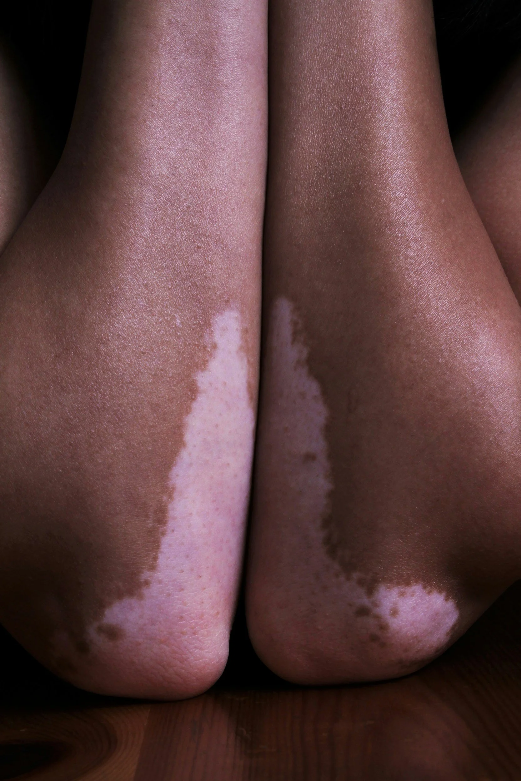 A close-up of two legs with vitiligo patches, showing skin discoloration and uneven pigmentation.