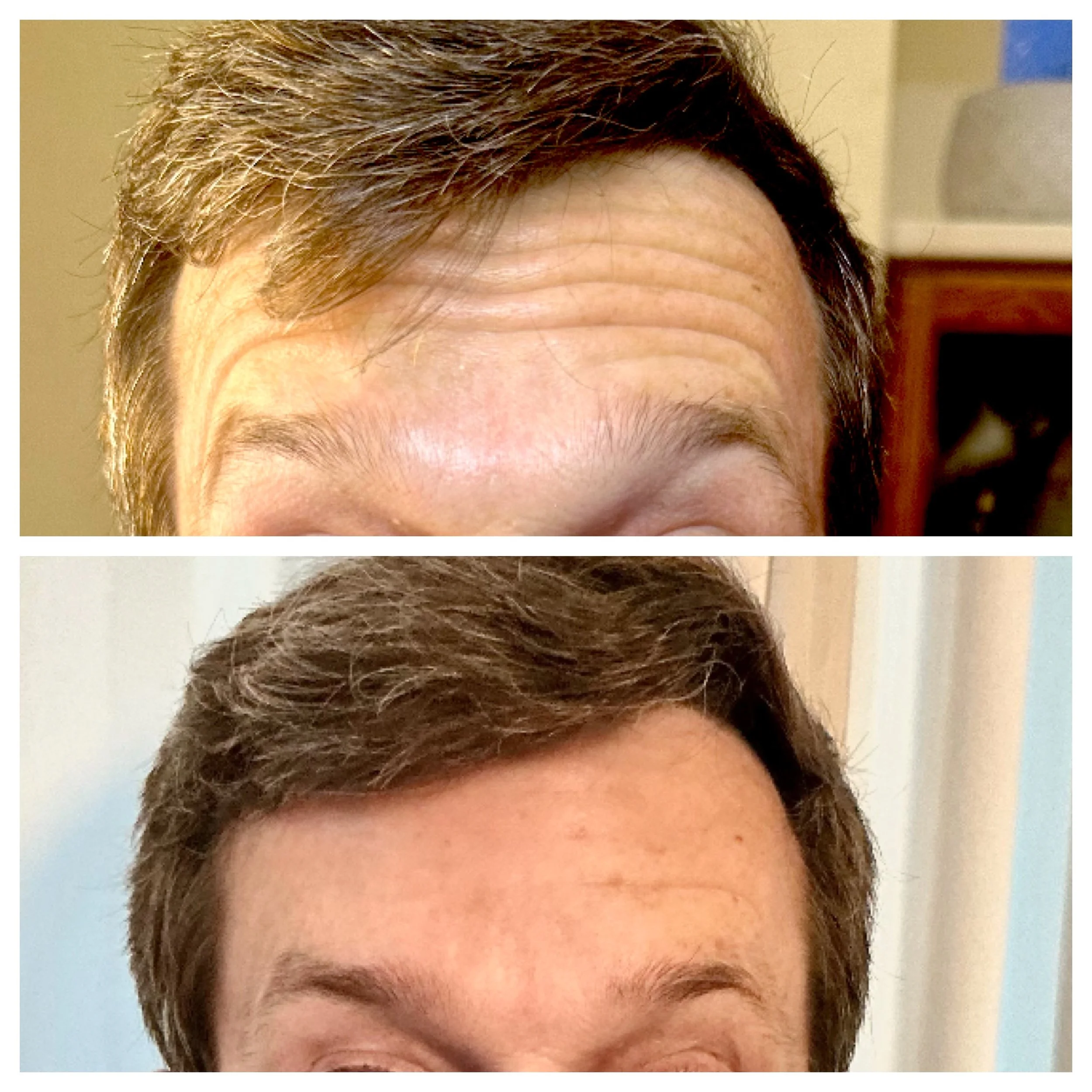 Comparison of a person's forehead, showing wrinkles in the 'before' image and smoother skin in the 'after' image.