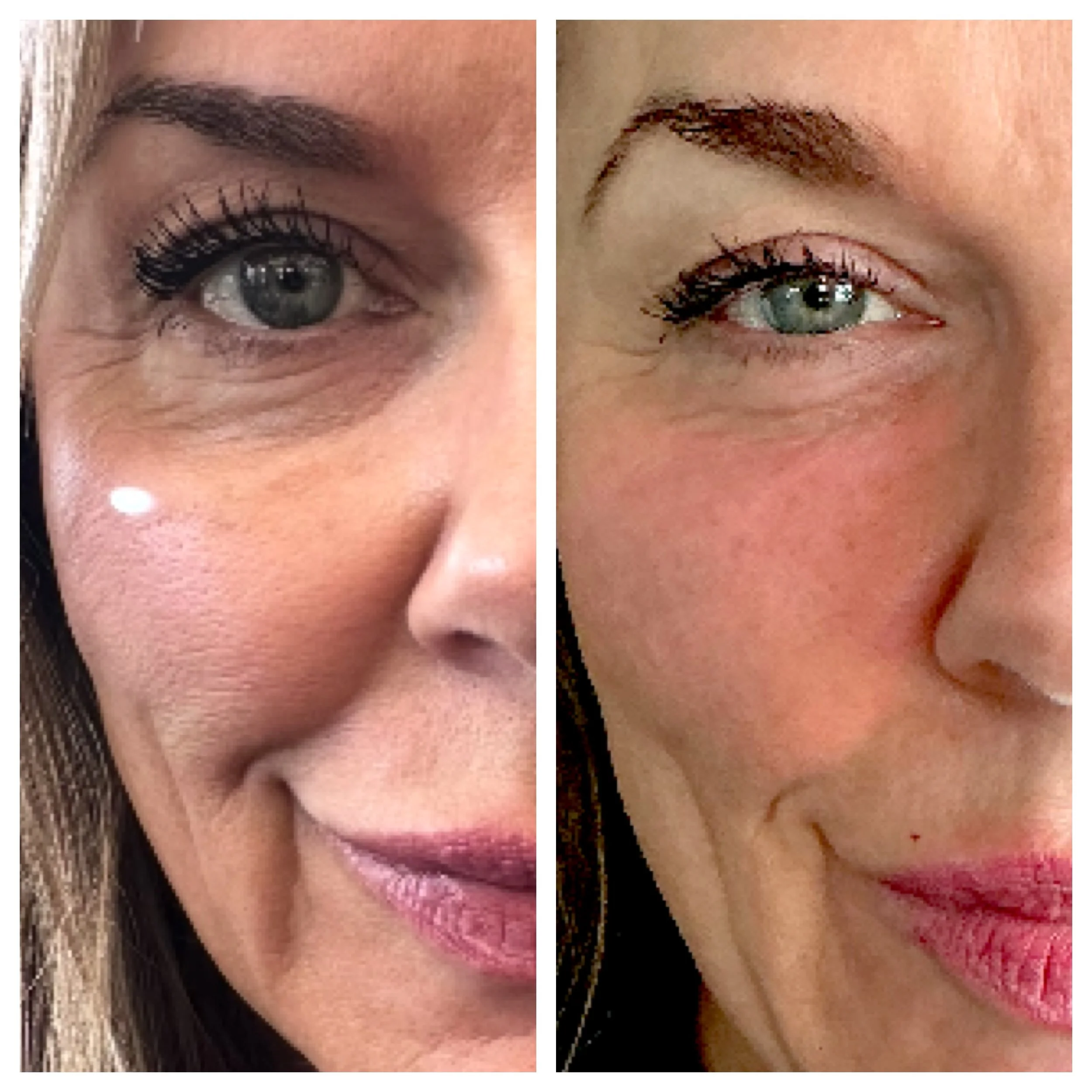 Close-up of a woman's face showing a side-by-side comparison of her skin with and without wrinkles, highlighting the effects of skincare or cosmetic procedures.