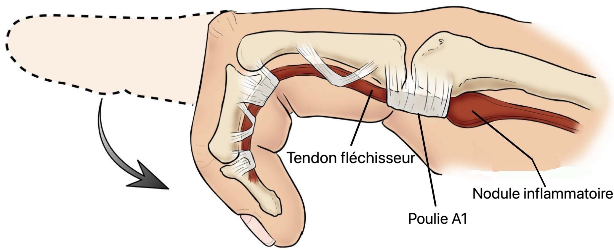 Schéma Doigt à ressaut