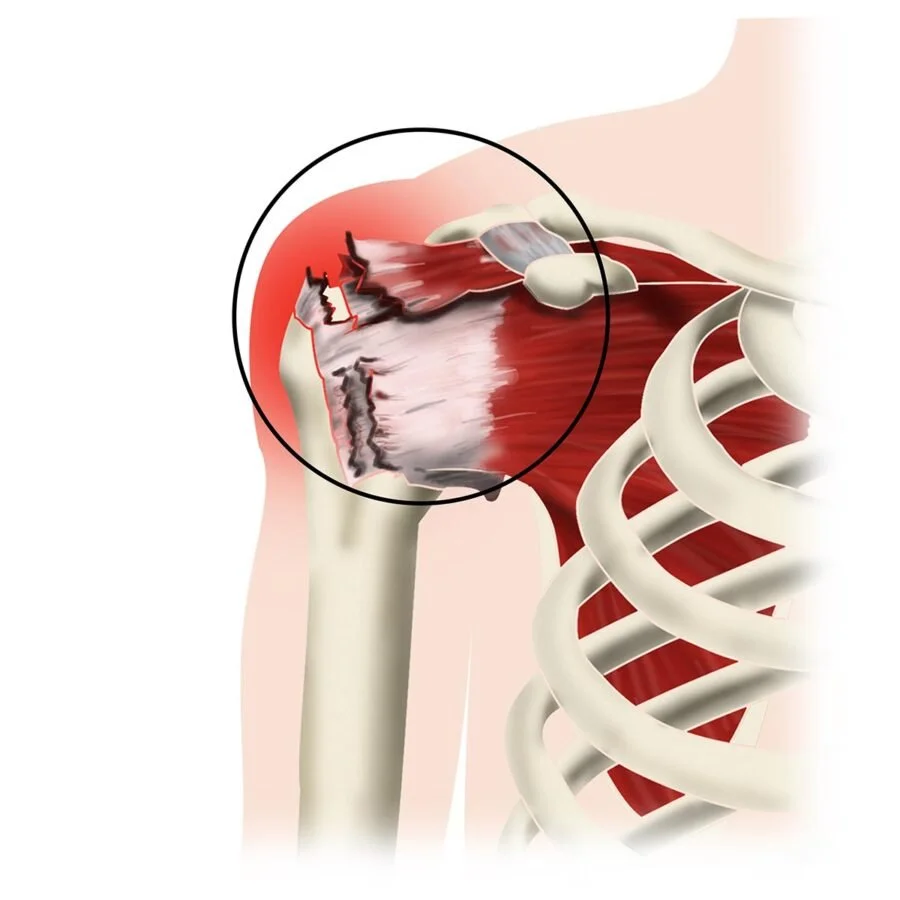 Schéma rupture de la coiffe