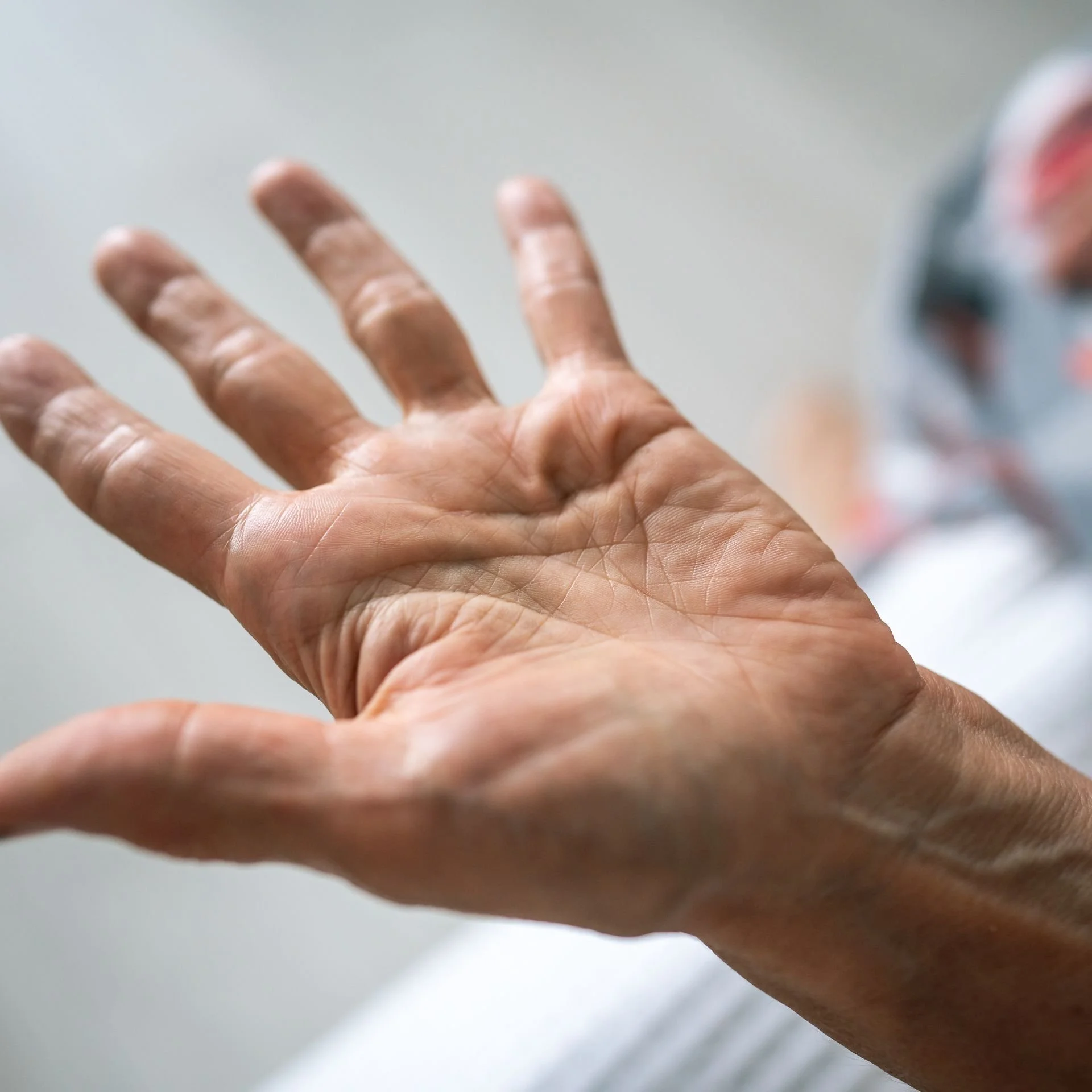 Homme présentant la maladie de Dupuytren à la main