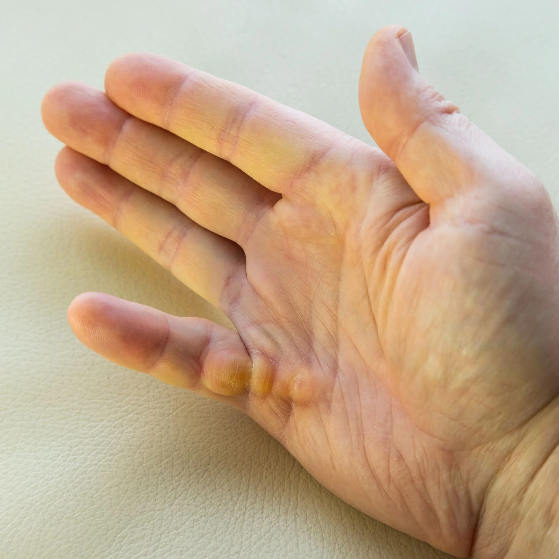 Homme âgé atteint de la maladie de Dupuytren à la main droite