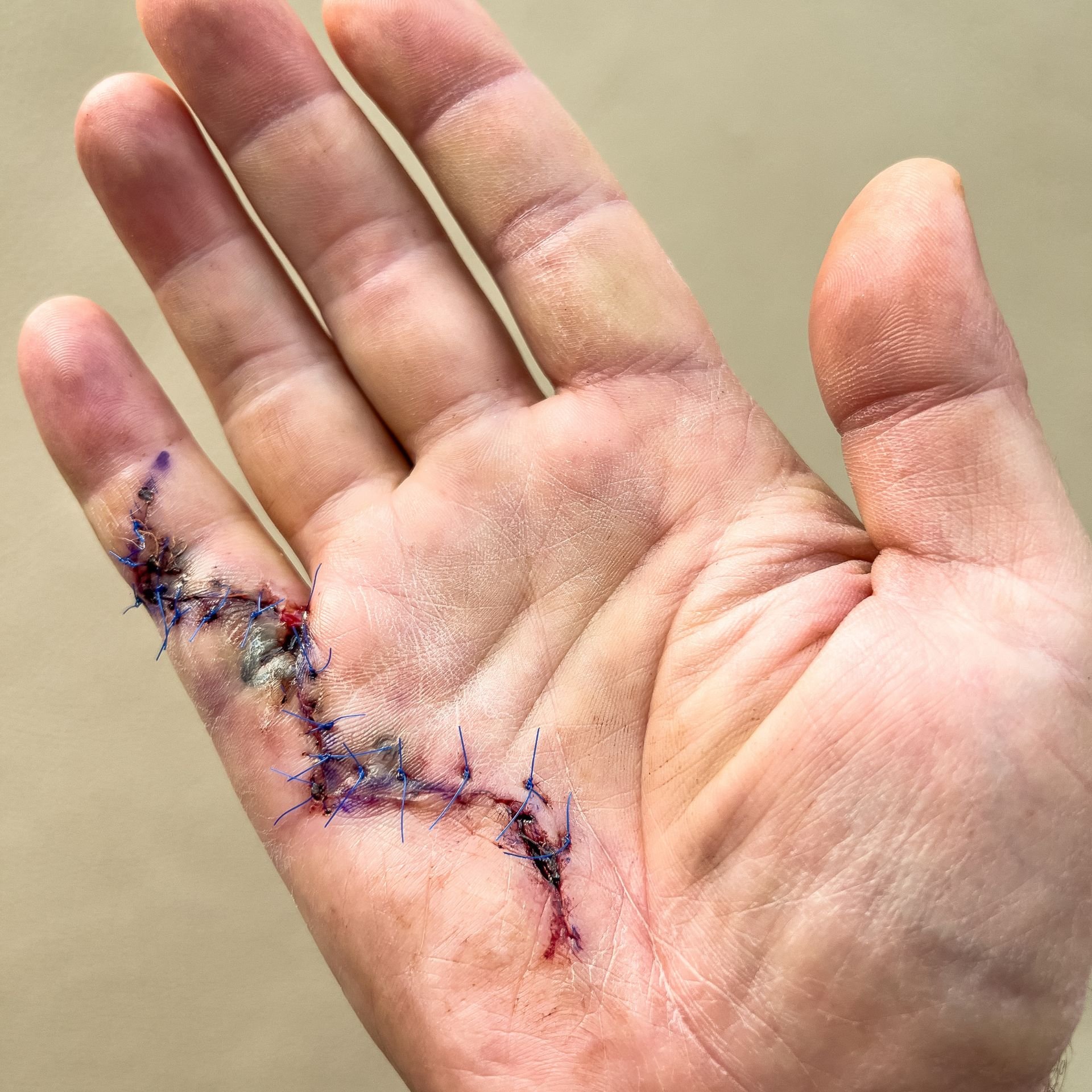 Main opérée de la maladie de Dupuytren