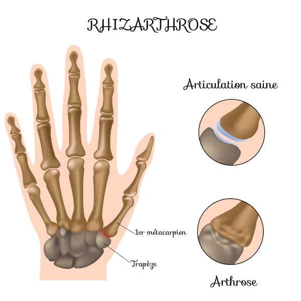 Schéma d'une Rhizarthrose