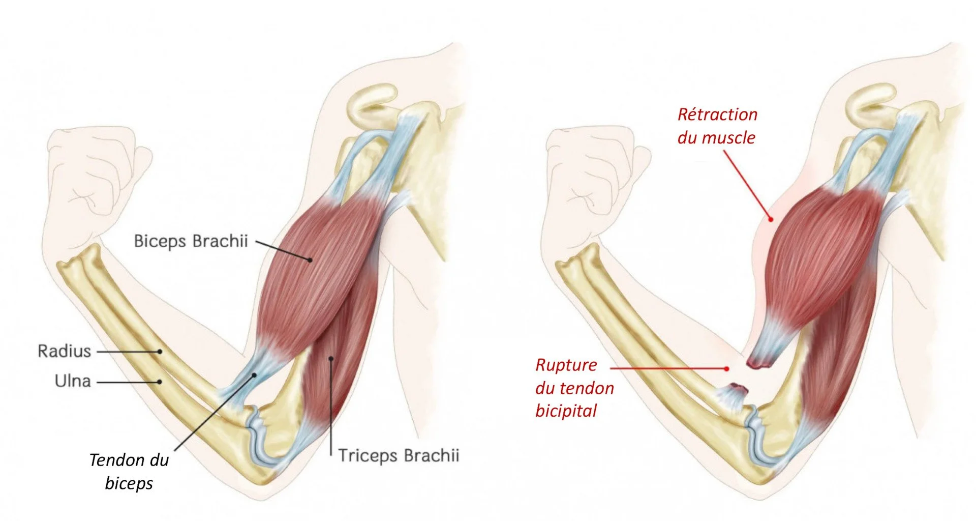 Schéma rupture biceps