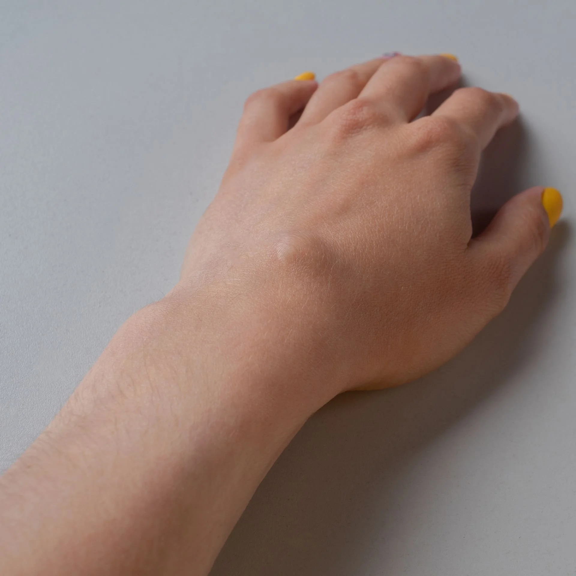 kyste synovial du poignet