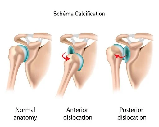 Schéma calcification