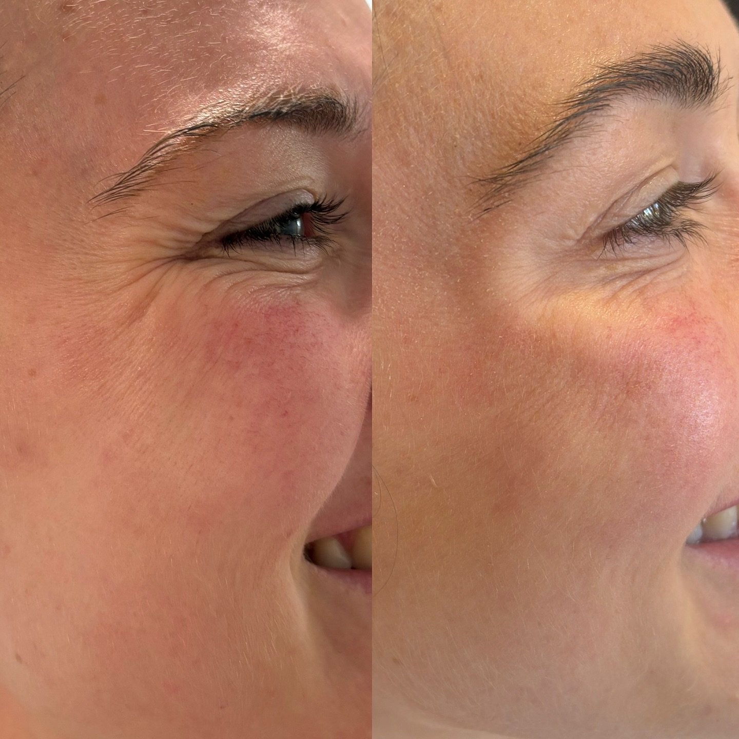It&rsquo;s not about erasing every line &mdash; it&rsquo;s about softening, refreshing, and enhancing what&rsquo;s already beautiful.

Smile lines tell your story, and we&rsquo;re here to help them look a little more rested while keeping your natural