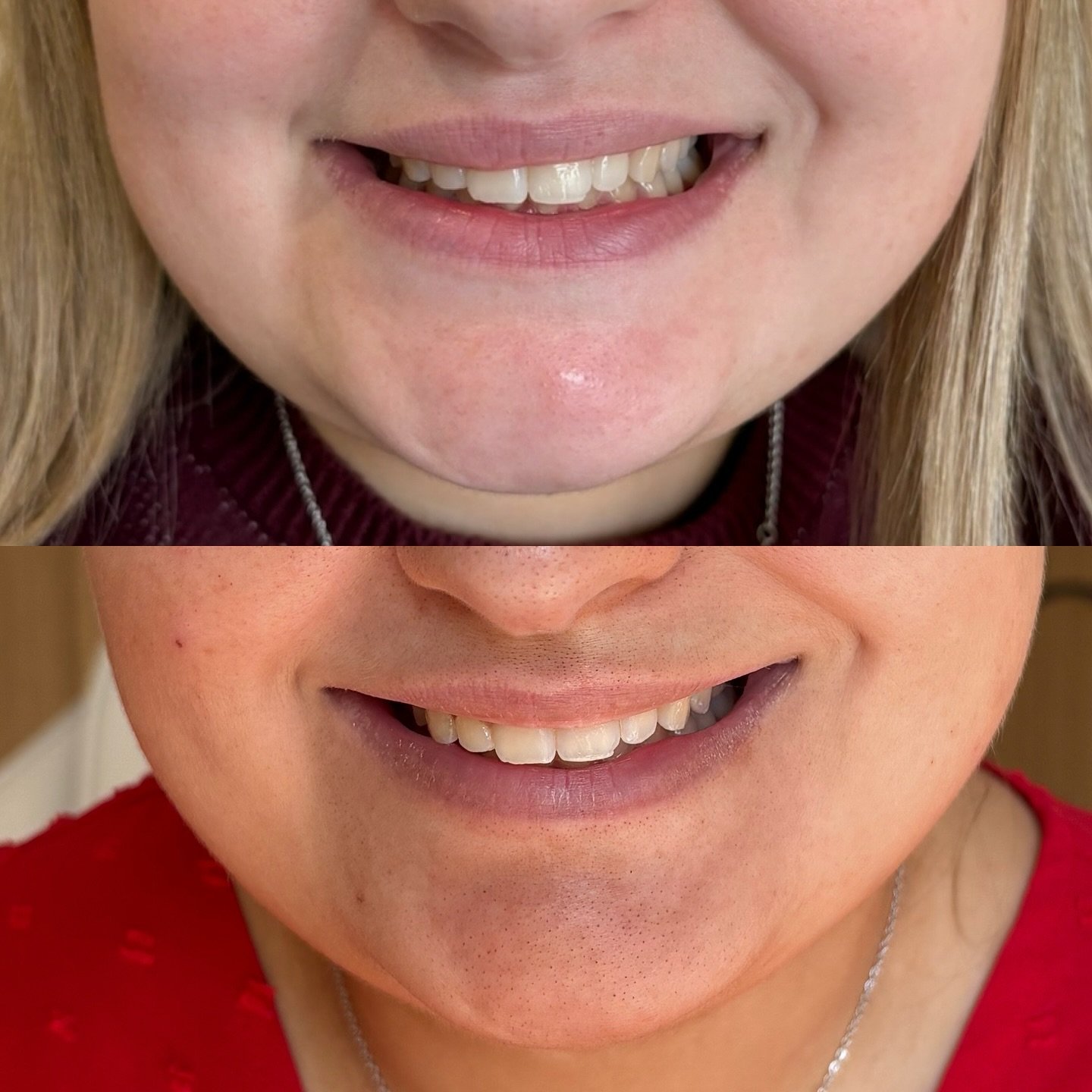 This beautiful client came in with a naturally asymmetric smile &mdash; something that had always made her a little self-conscious. With just a small amount of carefully placed product, we&rsquo;ve restored balance and symmetry, enhancing her natural