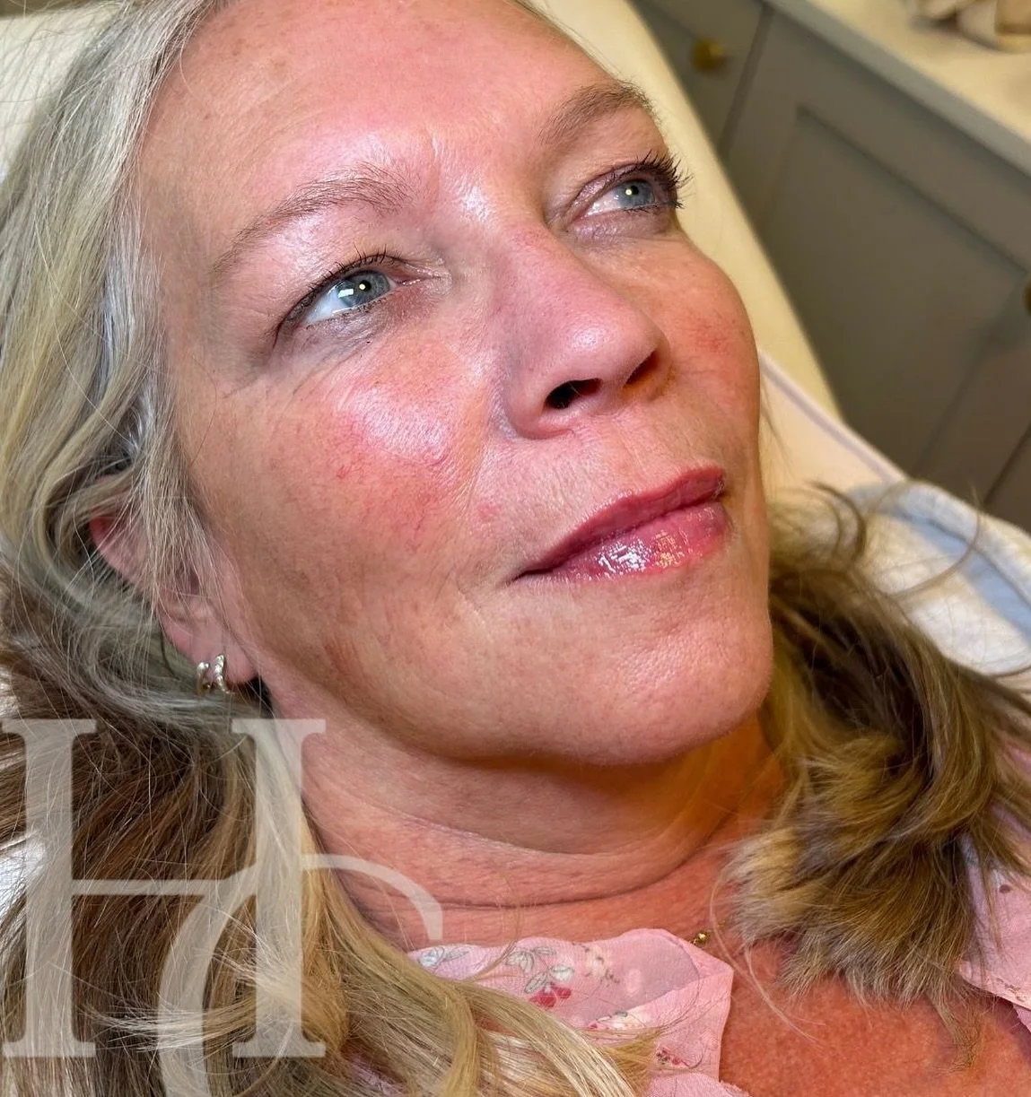 At HCM Elegance, lip filler isn&rsquo;t about over-volumising &ndash; it&rsquo;s about restoring natural hydration and softness. 

Our approach focuses on subtle enhancement, helping lips look smoother, healthier, and refreshed rather than dramatical