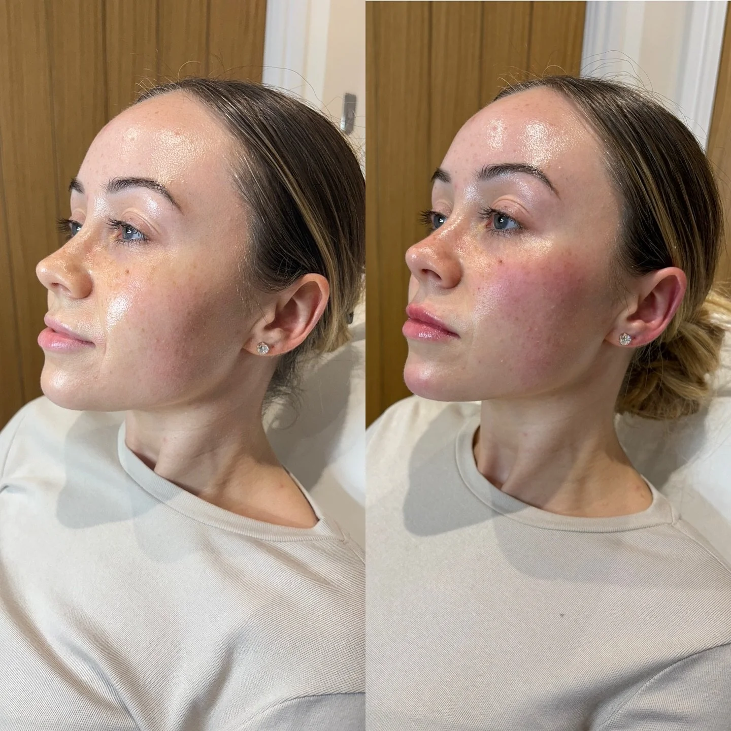 Not every treatment needs to be obvious. 

With profile balancing, the aim isn&rsquo;t to change your face, but to create harmony between your features. The most beautiful results are often the ones that simply make you look refreshed, confident, and