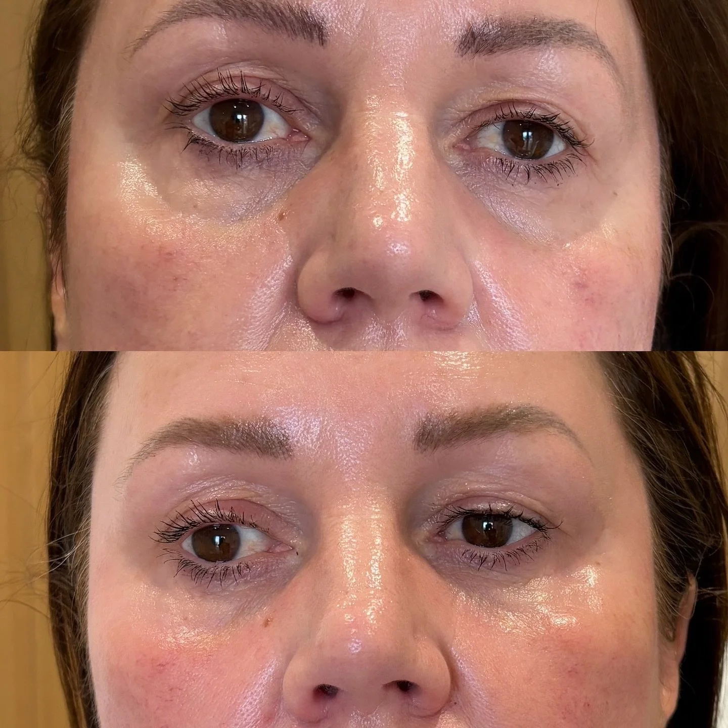 Tired-looking eyes can often be down to volume loss beneath the eyes, leaving hollowing or shadows. Dermal filler treatments can restore subtle volume, helping you look well-rested and rejuvenated &mdash; without changing your natural features

👀 Re