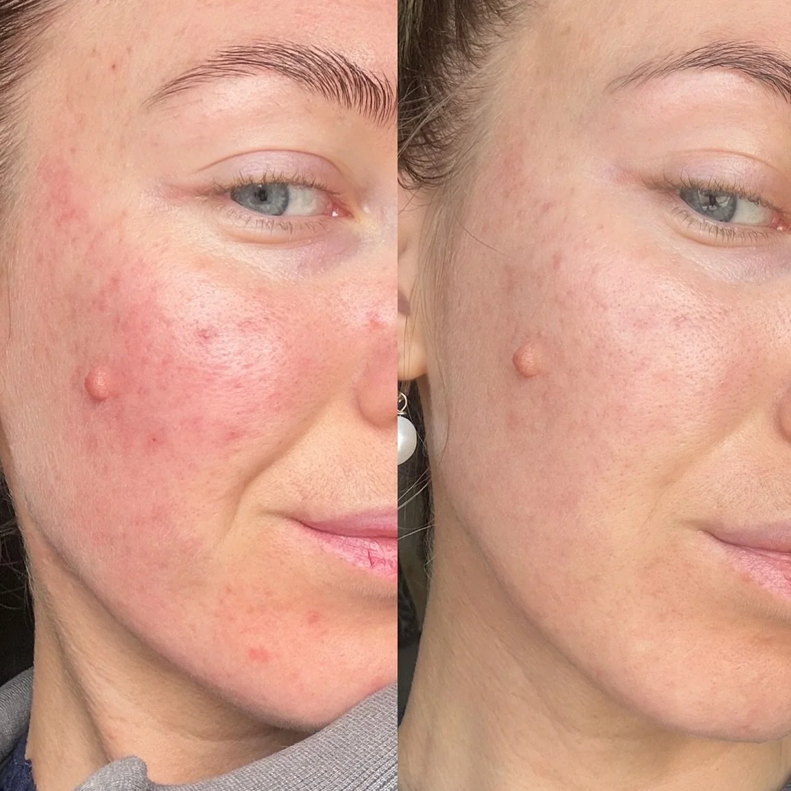 Personal polynucleotide results 🫶🏻 now I do like trying things out for myself before I rave about them. 

I&rsquo;ve always struggled with inflammation and acne scarring, and finding a treatment that actually works (without masking the issue) has b