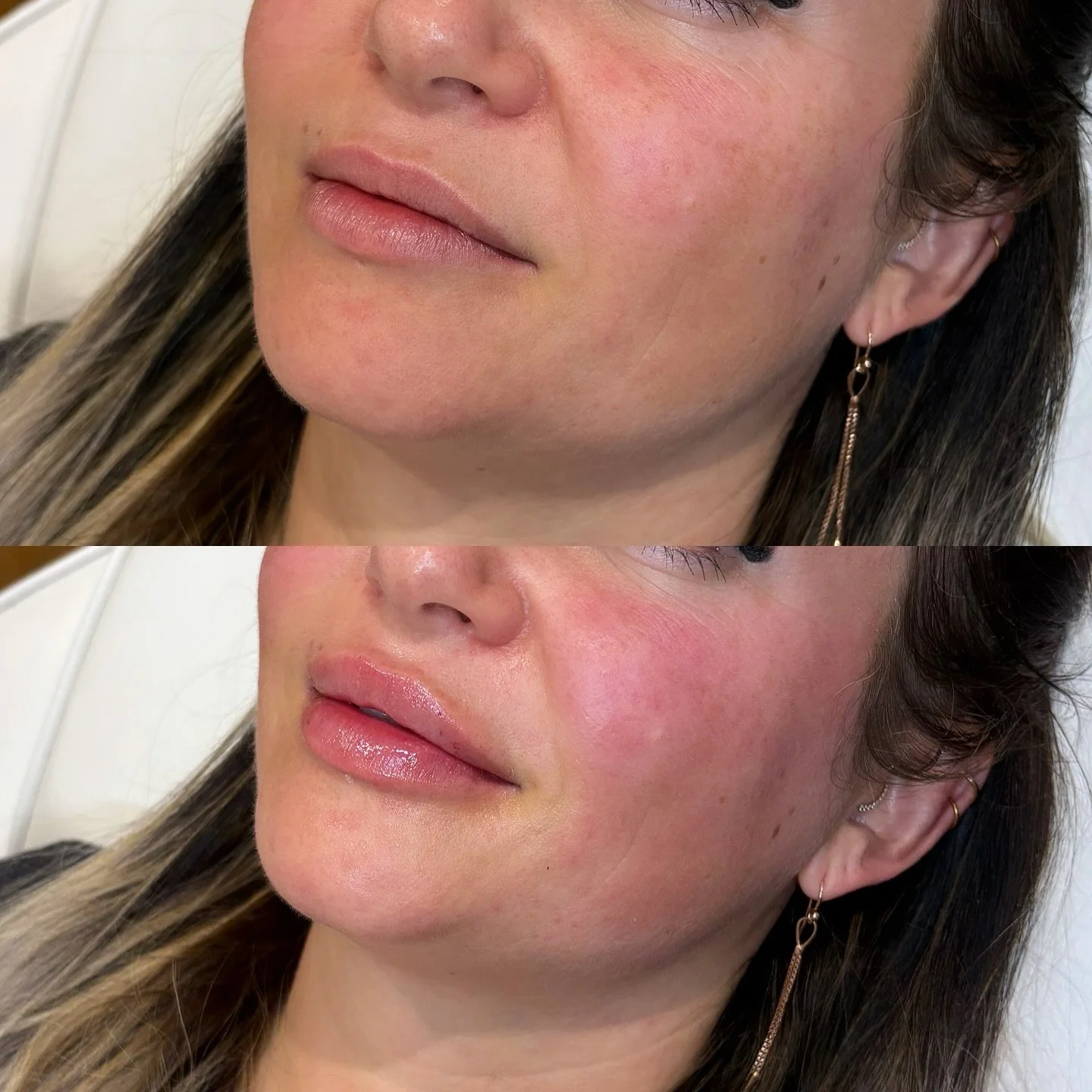 Why I Don&rsquo;t Offer &ldquo;0.5ml&rdquo; or &ldquo;1ml&rdquo; Lips 

I often get asked if I offer half ml or 1ml lip filler appointments &mdash; and the answer is no 💉

Here&rsquo;s why 👇
Every face, every lip, and every goal is completely uniqu