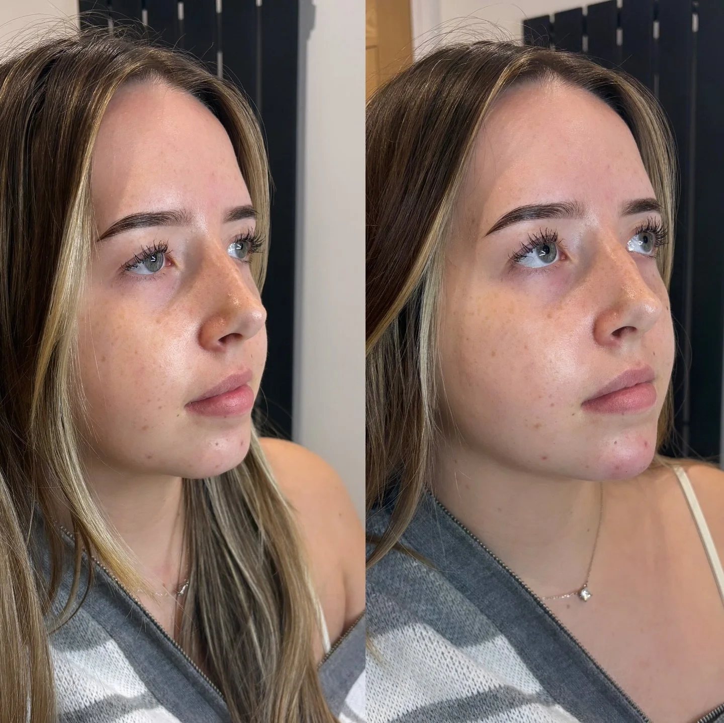 Chin filler to softly sculpt and enhance the natural harmony of your features

Book your bespoke consultation at HCM Elegance and discover balance in every detail.

#HCMElegance #NaturalResults #FacialRefinement&rdquo;