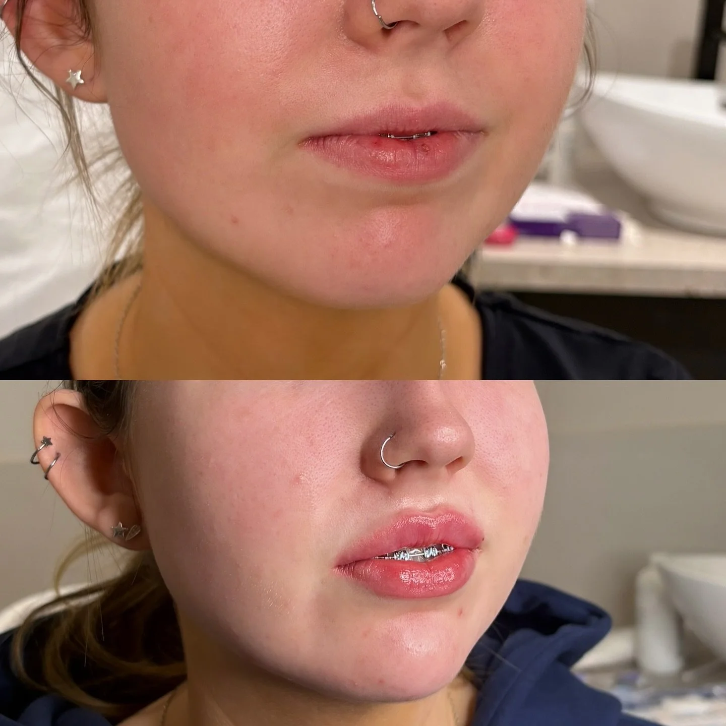 Lips that look naturally full and photo-ready 

Perfect for ANYONE wanting a soft, timeless enhancement.

From &pound;175 | Klarna available |