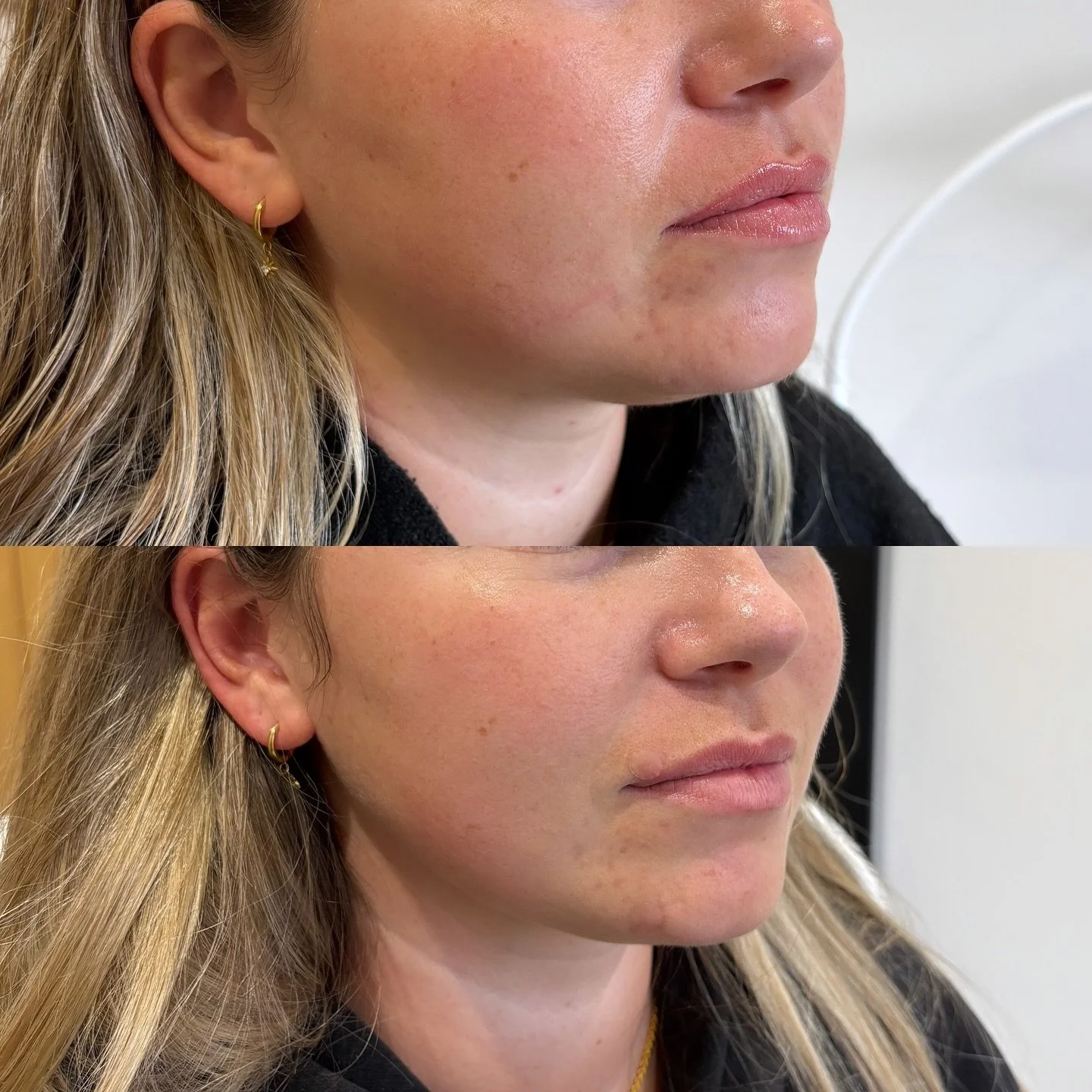 Can you guess which treatment this client had to achieve this STUNNING side profile? 

I&rsquo;ll give you a clue..this wasn&rsquo;t filler! 

Pop your guesses in the comments below! And if you&rsquo;re really interested in results like these..then h