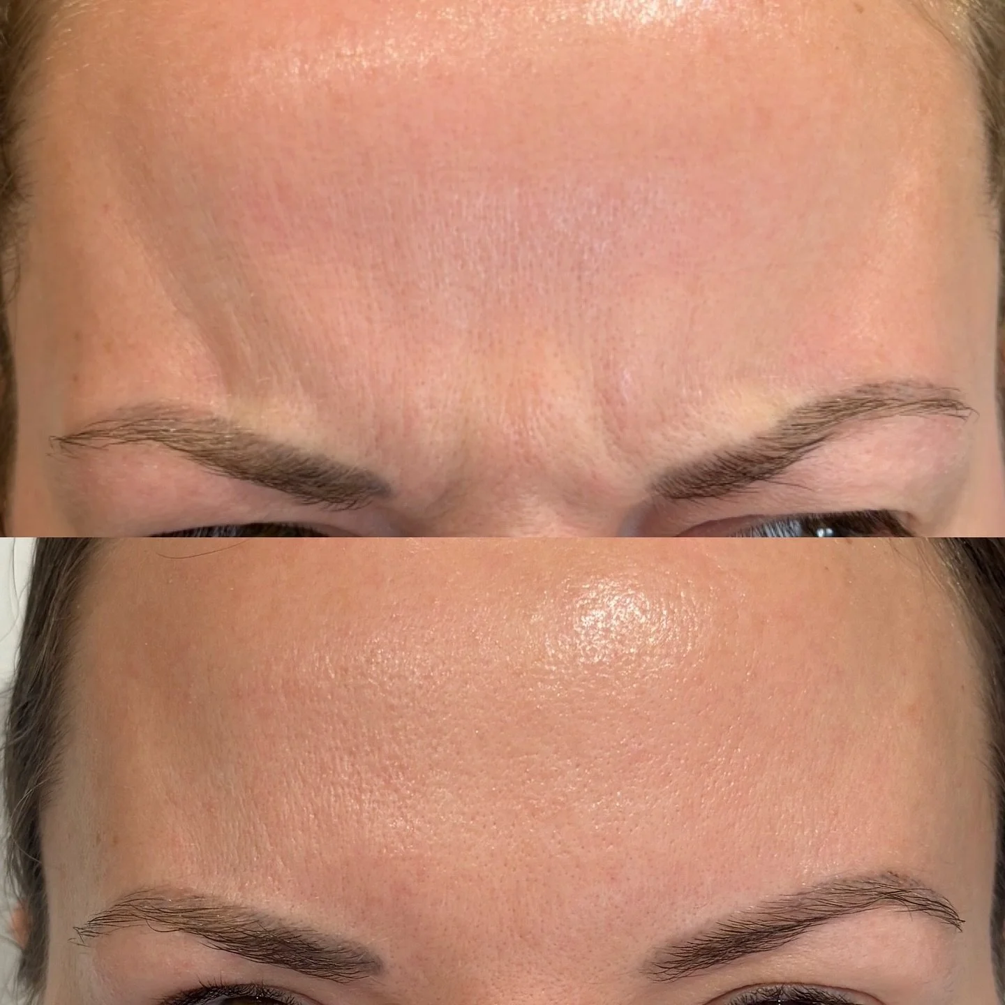 A touch of refinement &mdash; smoothing frown lines to restore a calm, confident expression.

Starting from &pound;185 

Link in bio to book