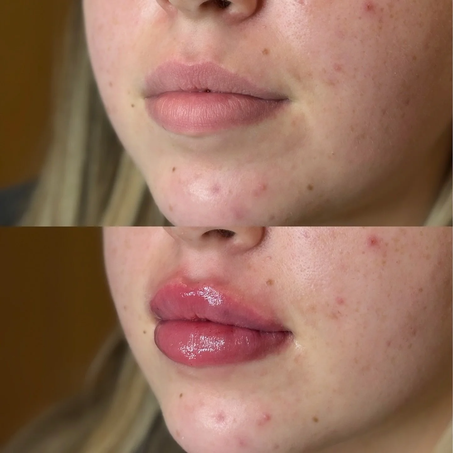 Oh Hi 👄 Not sure what to expect after lip filler? 

A little swelling &amp; tenderness after treatment is completely normal 👇🏼

Within the first 24&ndash;48 hours:
&bull; Lips will feel swollen + firm
&bull; Mild tenderness / slight bruising

Days