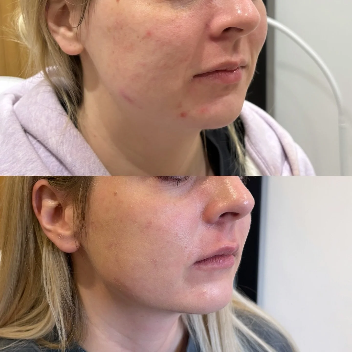 why you shouldn&rsquo;t neglect the lower face ⬇️

most people focus on the forehead and eyes, but the lower face plays a huge role in how youthful, balanced and lifted you look.

As we age:
-Muscles around the mouth pull downward
-The chin can becom