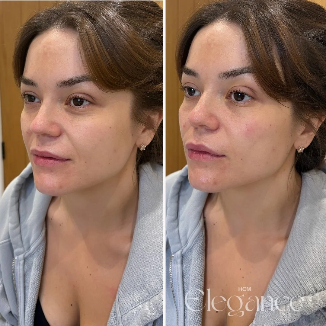Soft and sculpted 🤌🏼

Cheek filler doesn&rsquo;t just add volume, it lifts and supports the mid-face, helping to soften nasolabial folds naturally.
It&rsquo;s all about restoring balance and structure, not overfilling 💉

Results that enhance your 