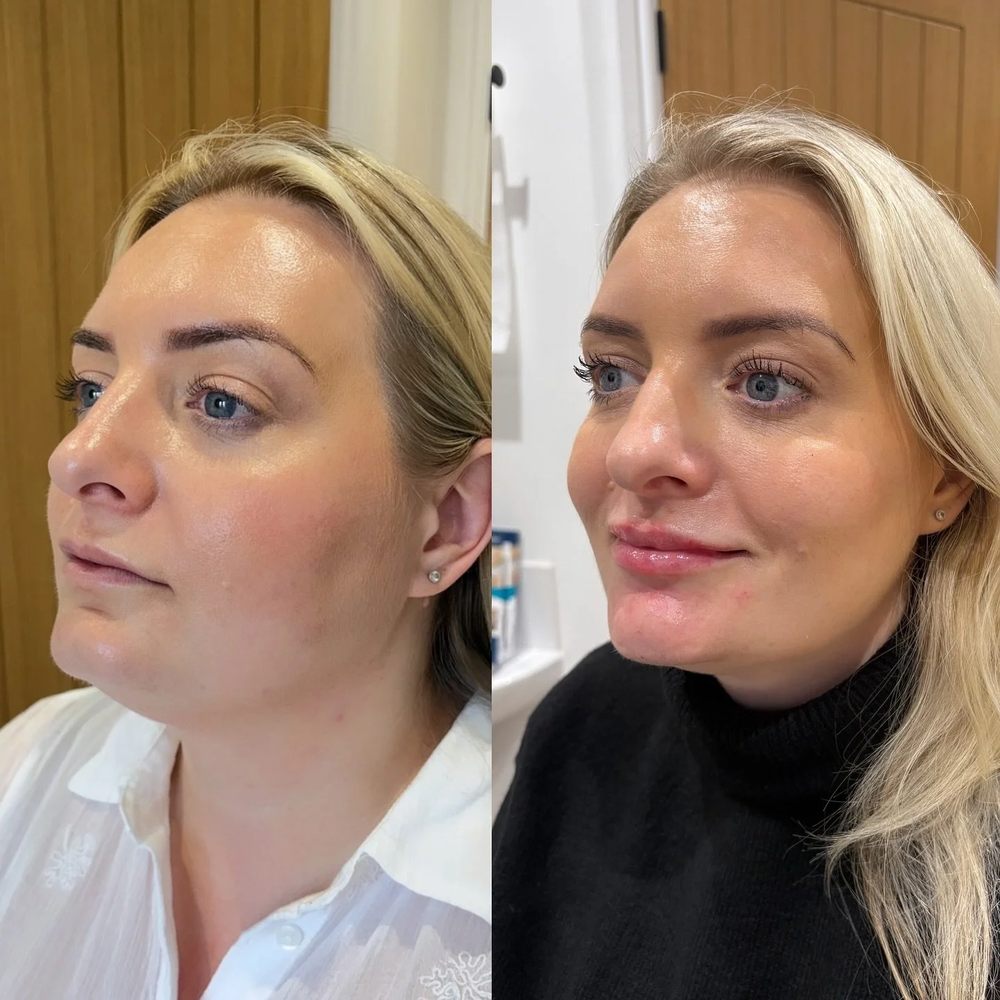 Two appointments, total glow-up ✨
Lower-face harmony unlocked&hellip;the smile says it all! 

Lip and chin combos 😮&zwj;💨

Subtle and beautiful.