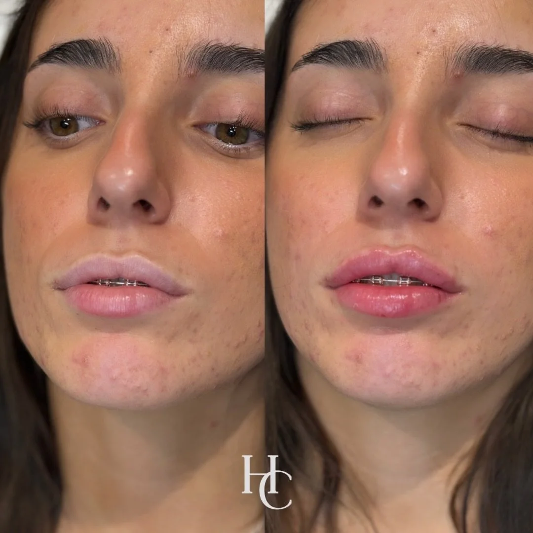 Confidence looks good on you 😮&zwj;💨

We focus on shape, symmetry, and hydration to create lips that look natural, feel smooth, and suit your face perfectly 🤍

-Subtle enhancement
-Natural definition
-Tailored to you

#LipFiller #NaturalLips #Aest