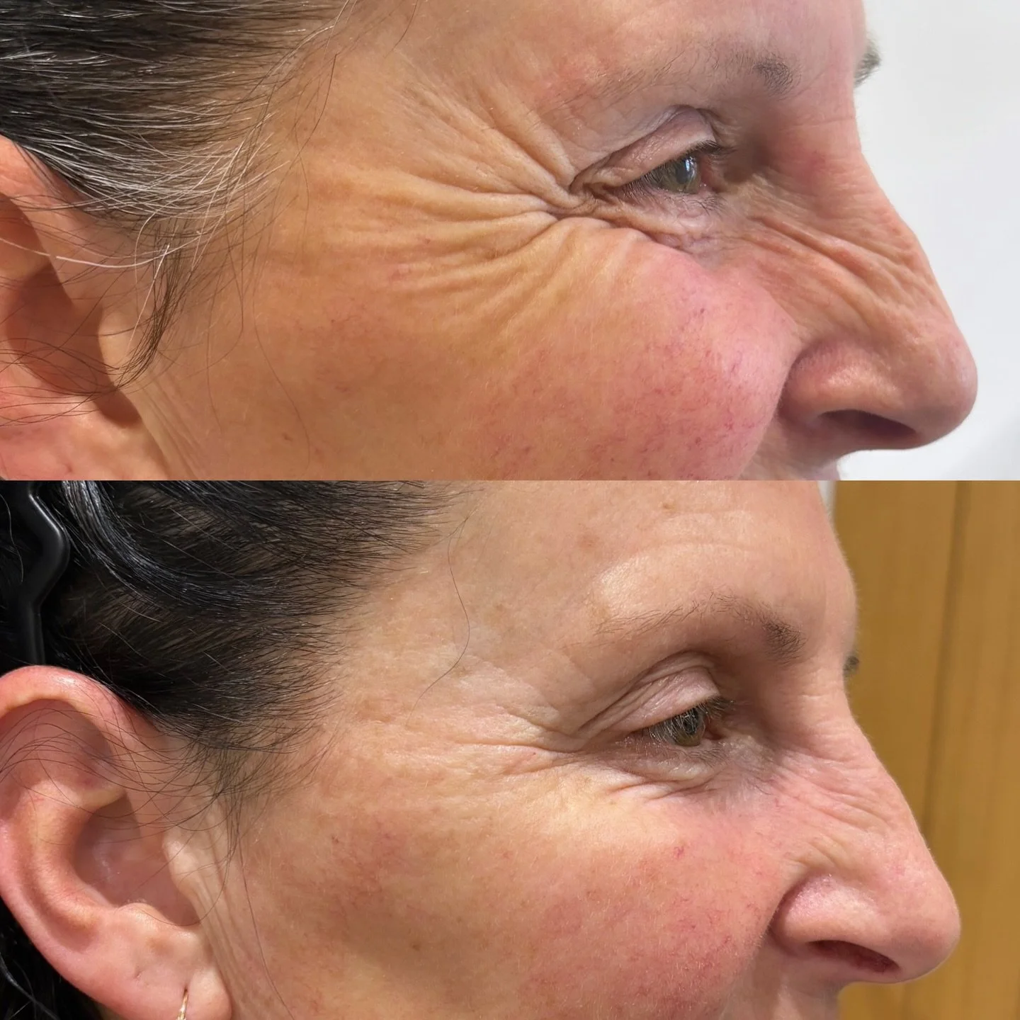 Softening those smile lines for a refreshed, rested look ✨