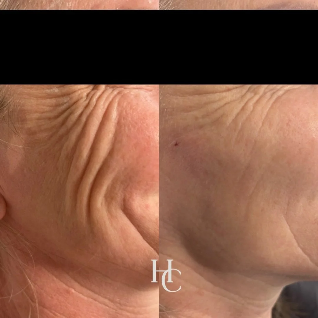 HYDROMAX!! 

The skin booster that delivers! 🤌🏼

I have just a couple appointments left for this incredible treatment!