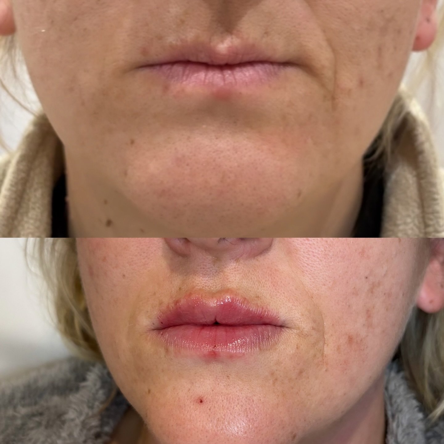 Two sessions 👄 

Plump and lifted 

Using Stylage by @vivacy_uk