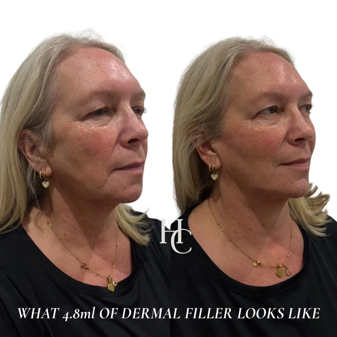 What if told you this is what nearly 5ml of dermal filler looks like? 

Using premium dermal filler expertly placed we were able to restore volume loss in the mid face and improve the appearance of jowls, whilst maintaining harmony and natural result