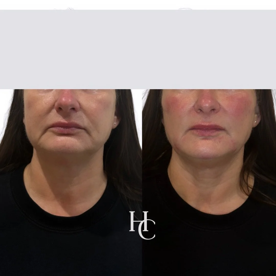 Mid &amp; Lower Face Transformation using @stylage by @vivacy_uk 
So in love with this gorgeous client result!

By focusing on the mid and lower face, we were able to restore structure, soften lines, and create a beautifully refreshed, naturally lift