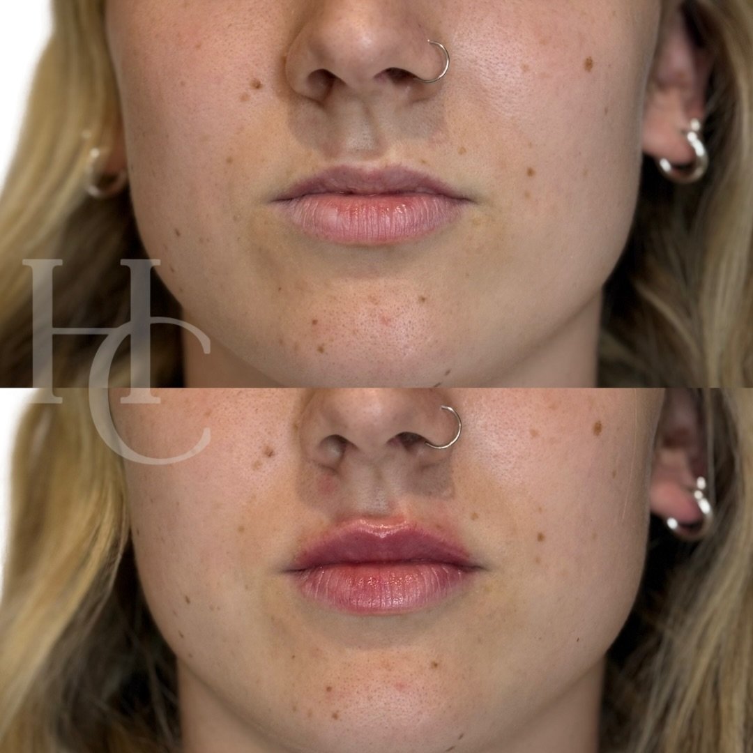 Pout perfection 💋 

@teoxane_uk for subtle enhancement focusing on the top lip