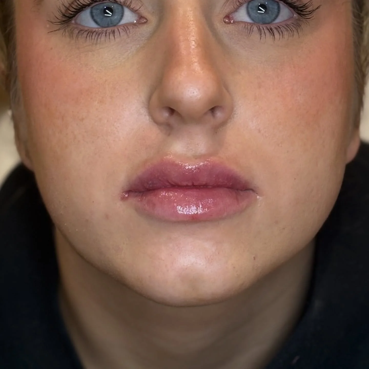 Dissolve &rarr; Refill &rarr; Refine 
A gentle, steady approach for lips that look natural, soft and beautifully enhanced.

Swipe to see the before &amp; after of this dissolve and refill journey ➡️💋

After removing old filler, we have started to re