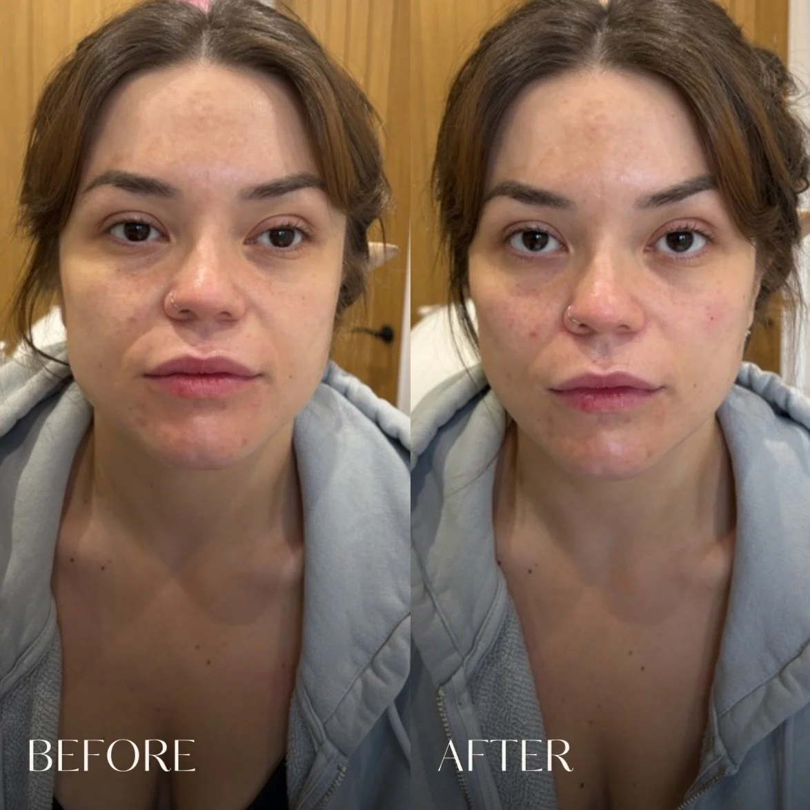 Subtle volume, balanced proportions, and natural movement&hellip; so you still look like you, just refreshed. 

Pricing from &pound;175
Consaltation recommended

#DermalFiller #NaturalResults #SubtleEnhancement #AestheticMedicine #FacialBalancing Les