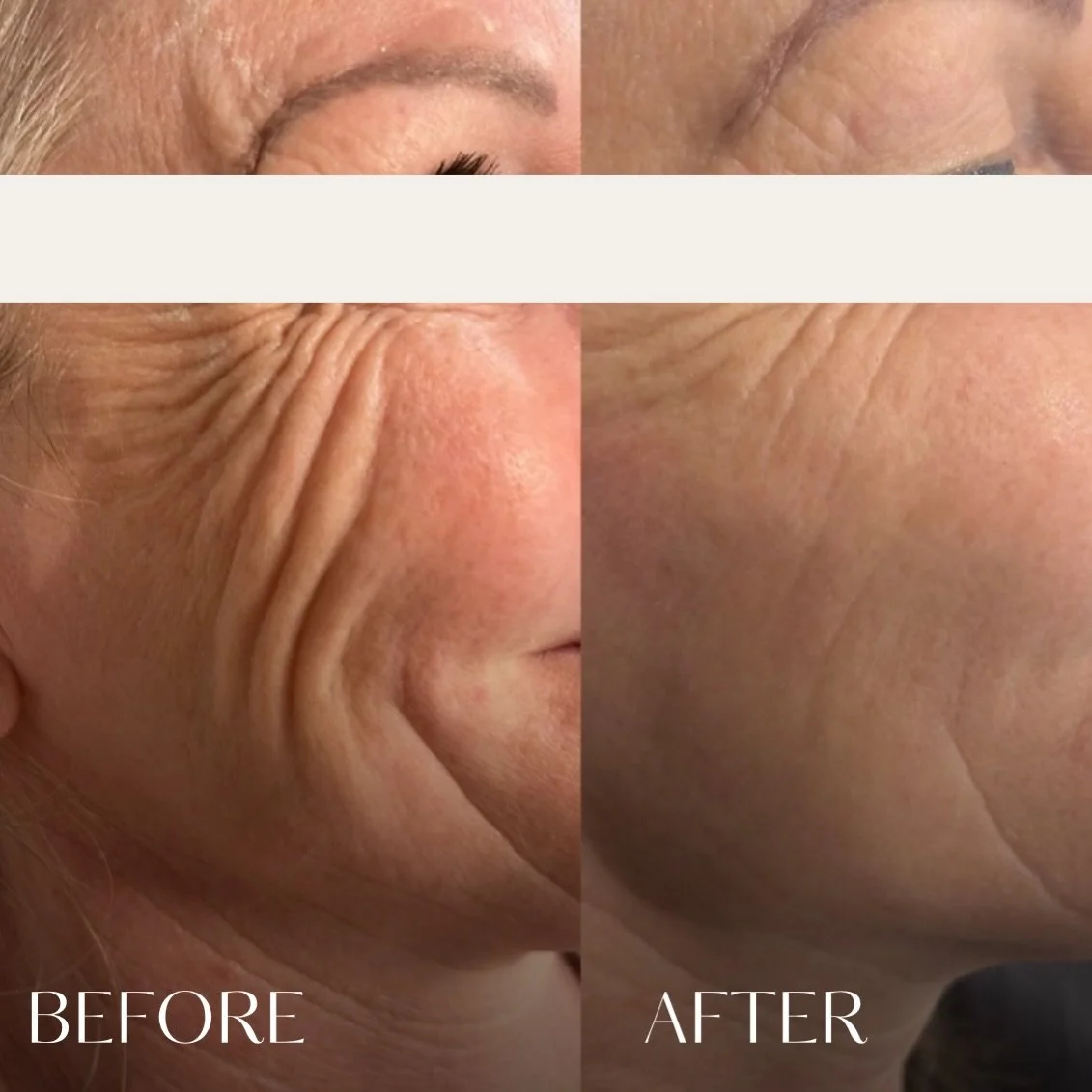 Not everything needs volume&hellip; sometimes your skin just needs hydration 💧

Hydromax boosts skin quality, improves texture, and gives you that healthy, radiant finish while still looking completely natural.

#Hydromax #InjectableSkincare #Aesthe