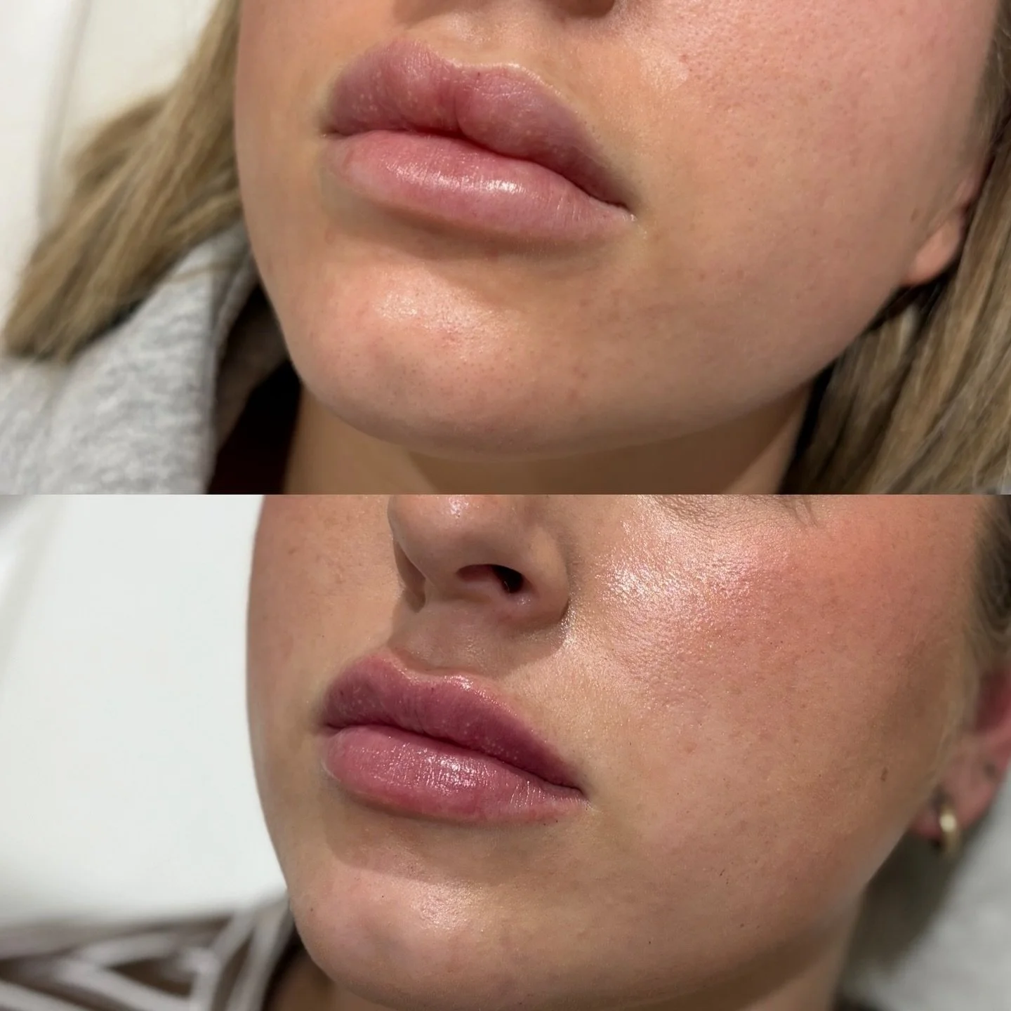 Swipe again for the before ➡️

This is a staged lip journey, not a quick fix.

First step: filler was dissolved to remove previous product and bring the lips back to a natural baseline.

Once swelling had settled and the tissue had calmed, a fresh, c
