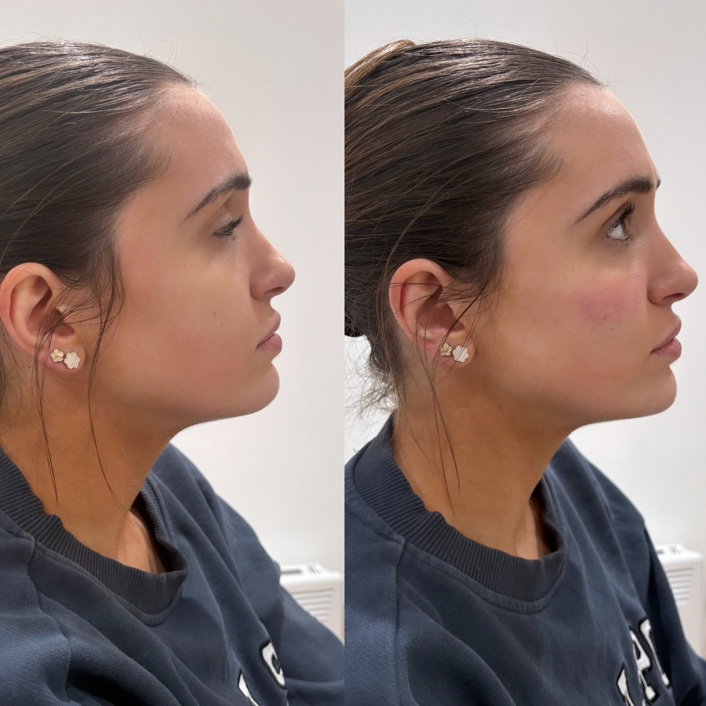 By assessing the face as a whole, we can enhance your natural structure, restoring support through the cheeks and refining the chin to bring everything into harmony 💉

The result? A softer, more lifted look where the lips often appear more proportio