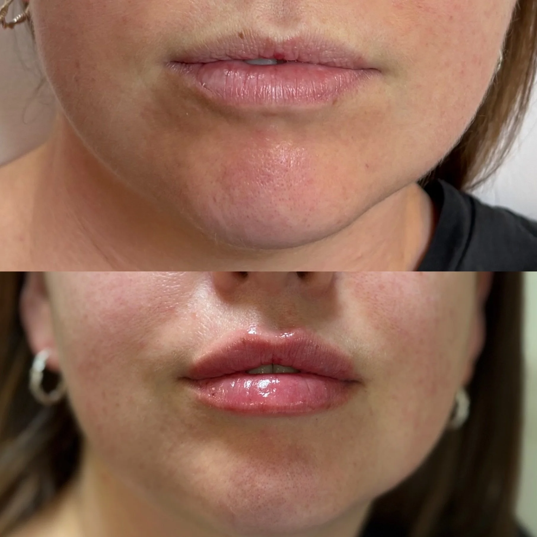 Soft volume, balanced shape, and a natural finish 💋

Treatment: Lip Enhancement
📍 Results tailored to facial harmony
📩 Link in bio to book