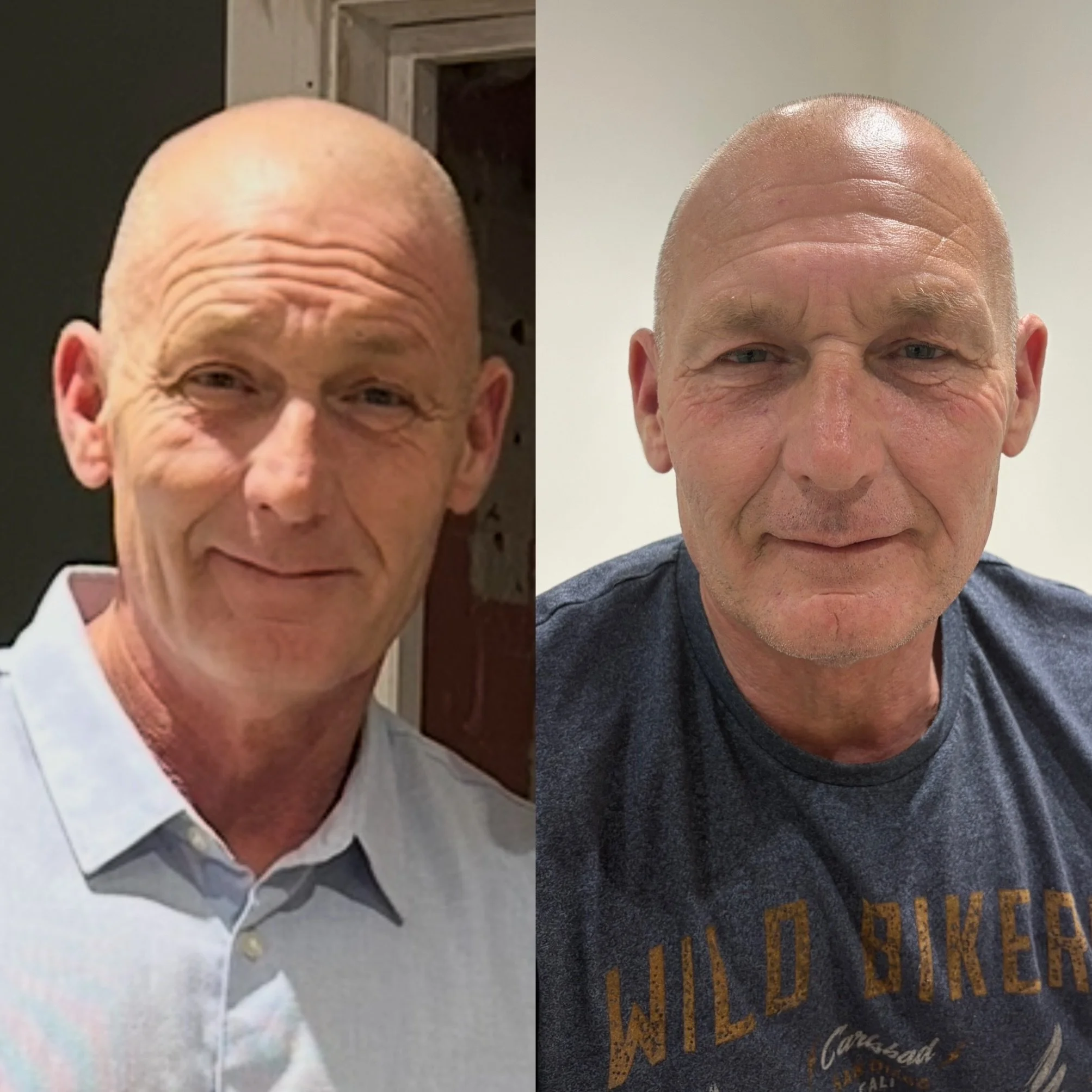 TWO years of consistency 

These results are down to a combination of treatments, lifestyle changes, and overall health improvements working together over time including polynucleotides, skin boosters, wrinkle treatment, microneedling, daily SPF, sto