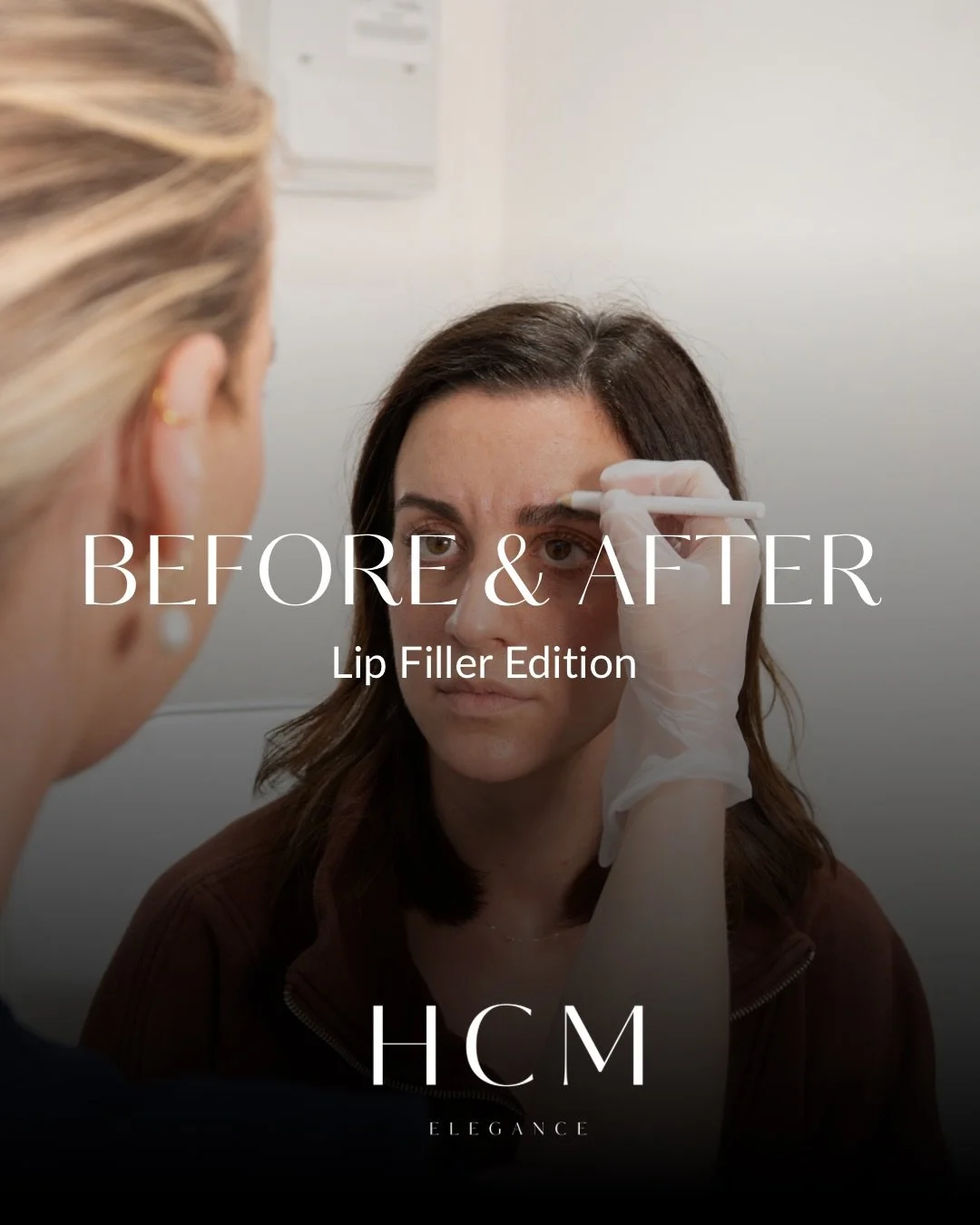 Subtle enhancement, balanced proportions &amp; natural volume, because the goal is always to look refreshed, not overdone.

Results immediately after treatment 💉
Minimal product used for a soft, hydrated finish.